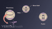 ACDF procedure showing discectomy, bone graft, plate, and fusion.