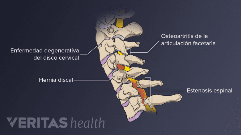 Condiciones que pueden ocurrir en la columna cervical.