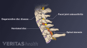 Medical illustration of common problems affecting the cervical spine. Degenerative disc disease, facet joint osteoarthritis, herniated disc, and spinal stenosis are highlighted.