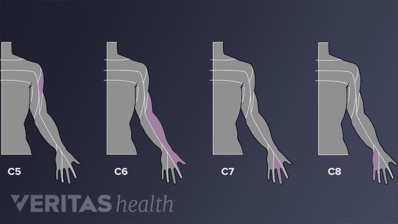 An illustration showing pain areas areas of pain distribution in the arm.