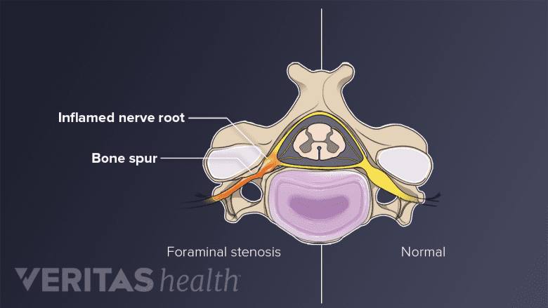 Illustration of nerve root inflammation from cervical foraminal stenosis, the common cause of cervical radiculopathy