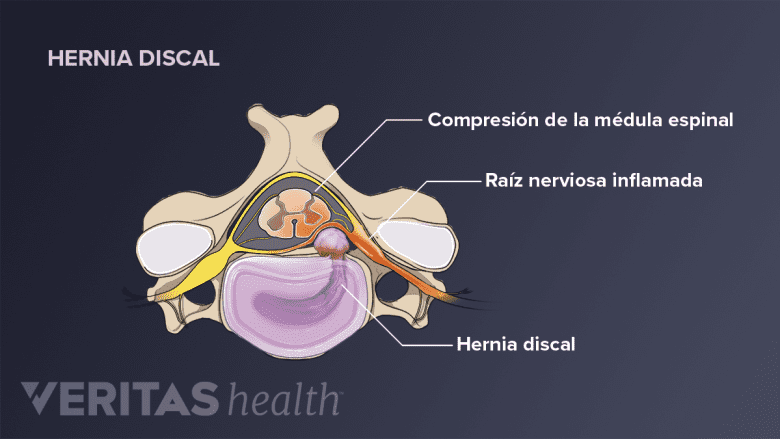 Una hernia de disco causando compresión.