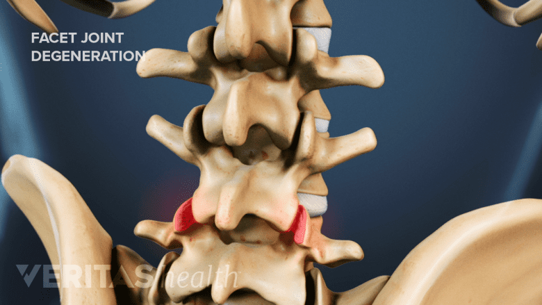 Illustration showing lumbar spine and pelvis with facet joints in red.