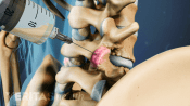 Injection being injected  into the facet joint.