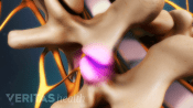 a portion of a facet joint may be removed to allow better access to the nerve root or to relieve nerve pressure.
