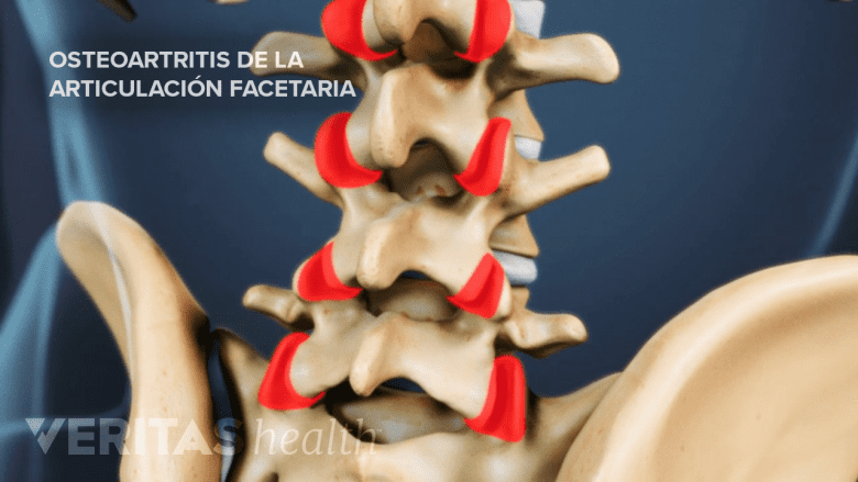 Osteoartritis de la articulación facetaria.