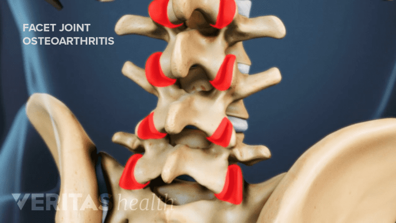 Osteoarthritis of the facet joints.