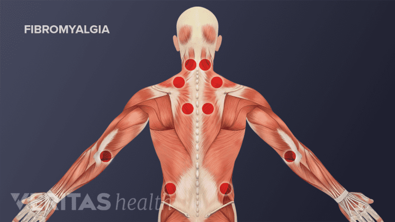 Medical illustration of fibromyalgia tender points.