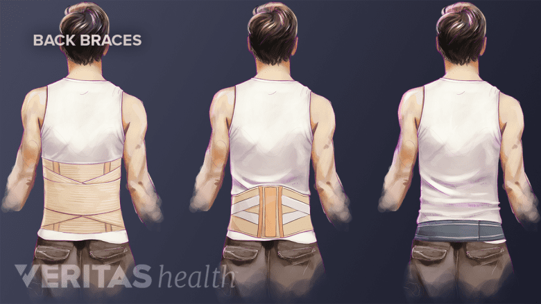 An illustration showing different types of braces.