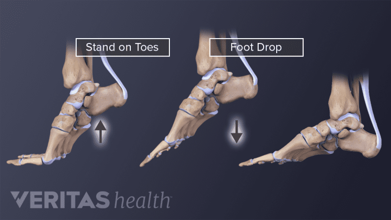 An illustration of an adult foot showing foot drop.