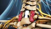Cervical Fusion