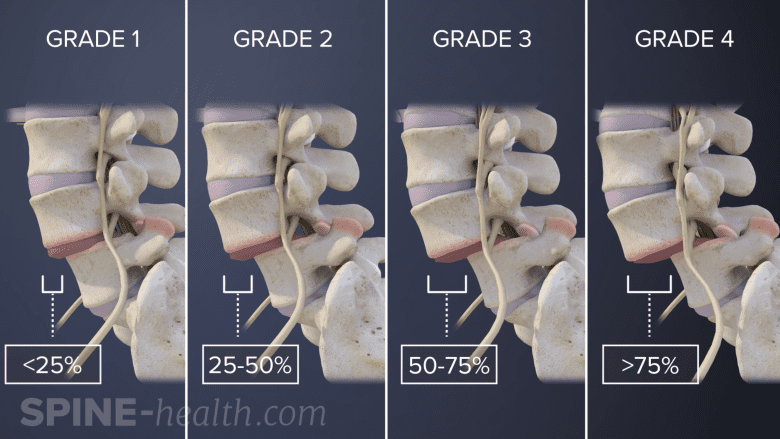 4 grades of degenerative- spondylolisthesis