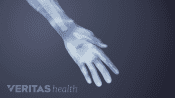 Hand and arm showing pain, tingling and numbness sensation