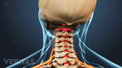 Posterior view of the cervical spine showing radiculopathy