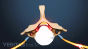 Superior view of spinal stenosis in a vertebra.