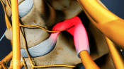 Pinched nerve from a herniated disc in the spine.