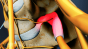 Profile view of a nerve root between two vertebrae.
