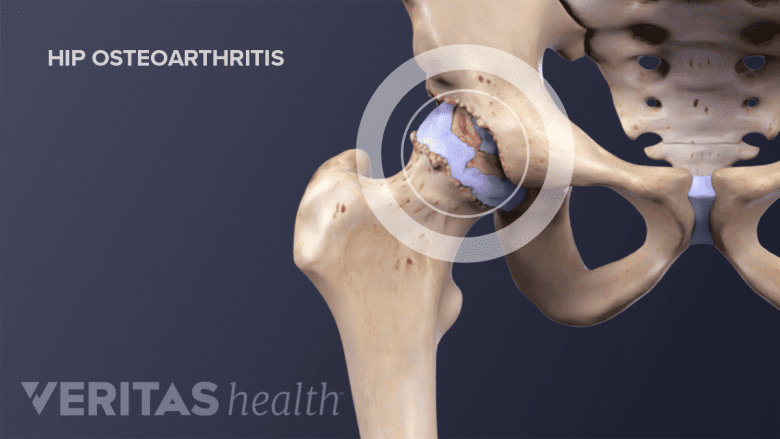 Osteoarthritis of the hip.