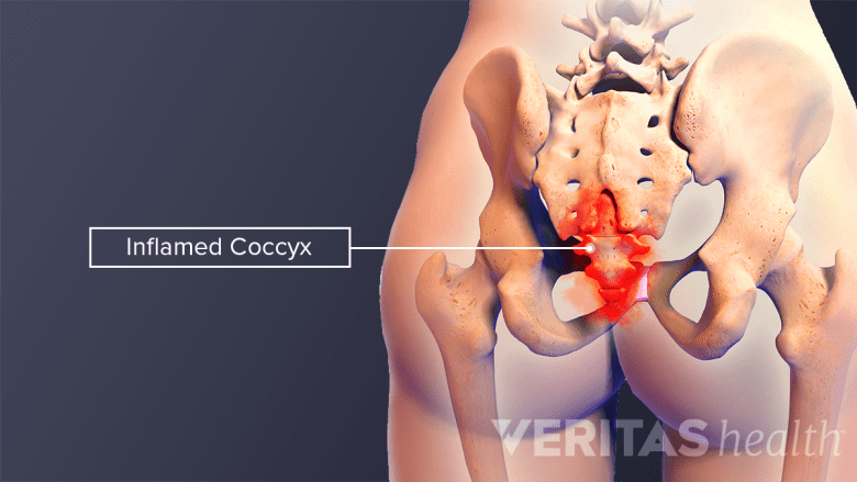 Illustration showing poterior view of hips and pelvis with coccyx highlighted in red.