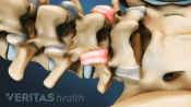 Posterior view of lumbar spine showing inflamed facet joints.