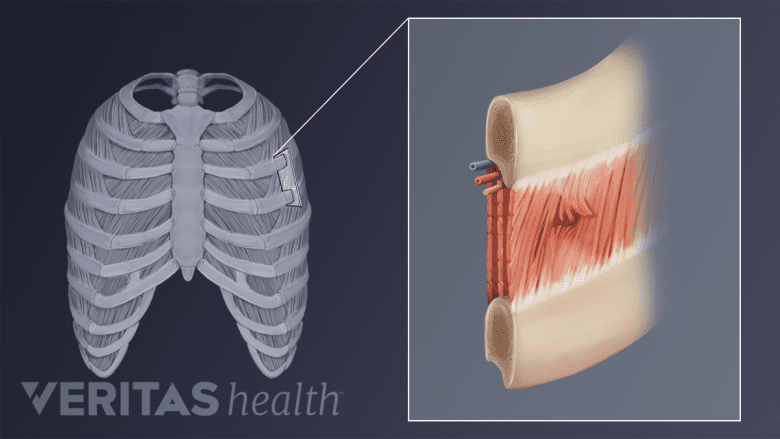 Illustration showing an intercostal muscle tear