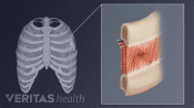 Illustration showing an intercostal muscle tear