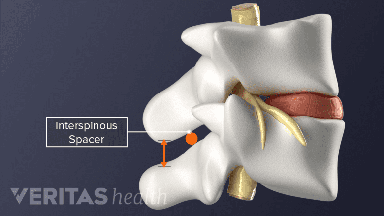 Interspinous spacer illustration showing restoration of disc height between two vertebrae.