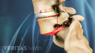 isthmic spondylolisthesis grades
