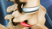Profile view of Isthmic Spondylolisthesis between L5 and S1.