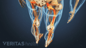 Isthmic Spondylolisthesis causing pain in the legs.