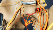 Isthmic spondylolisthesis in L5 and sacrum.