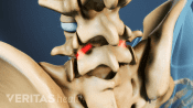 Posterior view of isthmic spondylolisthesis in the lumbar spine.