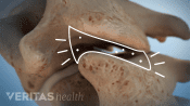 Illustration showing gas bubbles within the cervical facet joints that lead to crepitus