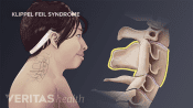 Medical illustration of klippel feil syndrome