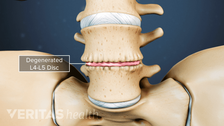Illustration showing degenerated L4-L5 disc.