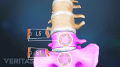 A medical illustration of the L5 and S1 vetebrae of the lower back.