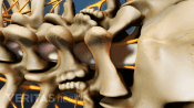 Posterior view of the multilevel spinal fusion in the lumbar spine.
