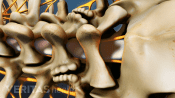 Posterior view of the multilevel spinal fusion in the lumbar spine.