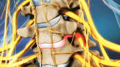 Anterior view of disc herniation in the cervical spine.