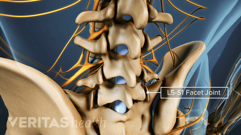 Posterior 3D view of the lumbar spine with the L5-S1 facet joints labeled.