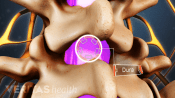 The ligamentum flavum is a membrane over the nerve roots which must be removed in order to enter the spine in a lumbar microdiscectomy.