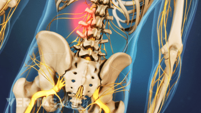 Lower Back Strain