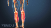 Medical illustration of the leg bones. The shins are highlighted in red to indicate pain