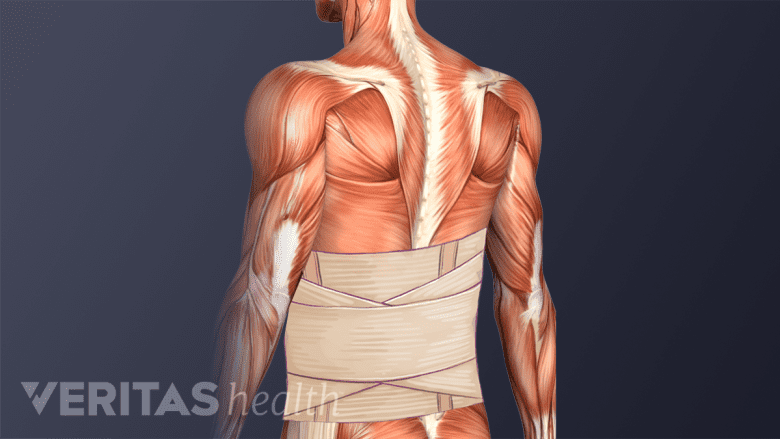Illustration showing back brace.