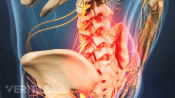 Medical illustration of the lower spine, highlighted in red indicating pain, numbness or tingling