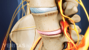 Degenerated disc in the lumbar spine