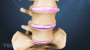 Anterior view of the lumbar spine with a needle being injected into the disc space.