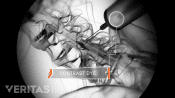 Xray of lumbar epidural steroid injection contrast dye going into the lumbar spine.