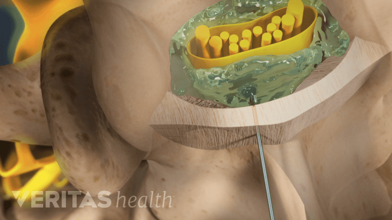 An illustration showing needle inserted in the epidural space.