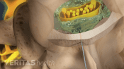 Epidural steroid injection injected into the nerve root